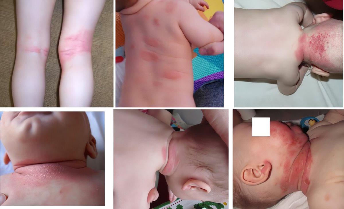 Různé projevy kvasinkové infekce na kůži (foto: autorka / ProAlergiky)
