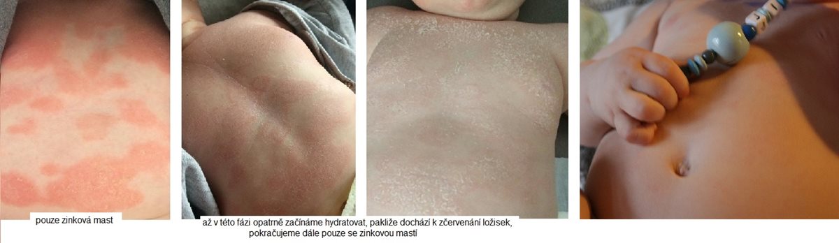 Fáze hojení kvasinkové infekce