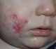 Kvasinková infekce kůže u dětí, její příznaky a léčba