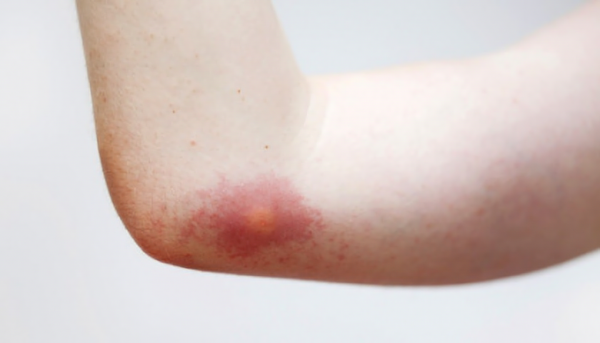 Alergie na léky se často projevuje jako nějaký druh vyrážky (foto: Thinkstock)