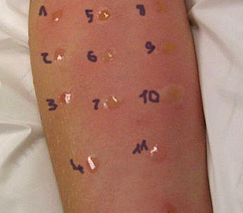 Vzorky alergenů nanesené na pokožce