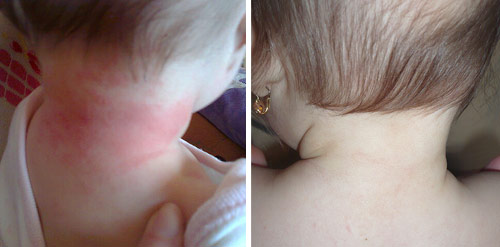 Uživatelka Rasha nám poslala fotky s jedním z nejvýraznějších zlepšení, které nastalo u její osmiměsíční dcerky Markétky